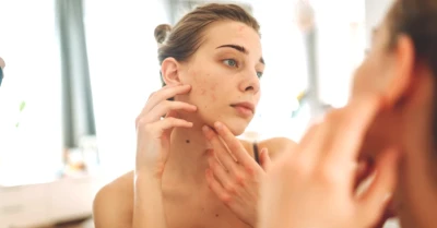 Akneye Farklı Bir Bakış! Sivilceler Cilt Yașlanmasını Engelleyebilir mi?