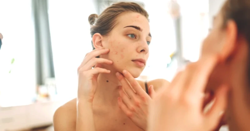 Akneye Farklı Bir Bakış! Sivilceler Cilt Yașlanmasını Engelleyebilir mi?